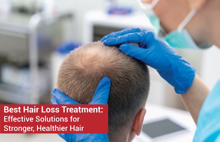 Best Hair Loss Treatment: Effective Solutions for Stronger, Healthier Hair